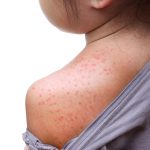 Red rash on baby skin at the back / Roseola infantum / Exanthema subitum / rose rash of infants / sixth disease / baby measles / three-day fever