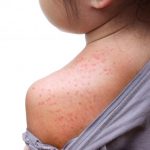 measles-chiled-weerapat1003-adobe-stock-696×464