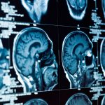Closeup of a CT scan with brain and skull on it